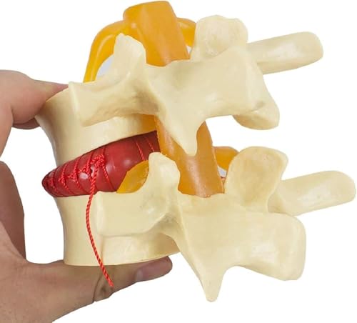 Demonstrationsmodell for Bandscheibenvorfälle in der Lendenwirbelsäule, anatomisches Modell der menschlichen Wirbelsäule, Modell for degenerative Erkrankungen der Lendenwirbelsäule, 1,5-faches Lehrmod von JvFbjLF