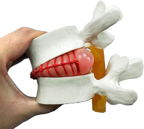 Modell der menschlichen Anatomie Wirbelsäulenmodell Demonstrationsmodell for Bandscheibenvorfälle in der Lendenwirbelsäule Modell der menschlichen Anatomie for degenerative Erkrankungen der Lendenwirb von JvFbjLF