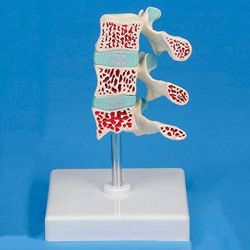 MFYHMY Wirbelsäulenmodell, Osteoporose-Modell, geeignet für medizinische Ausbildung, Ausbildungshilfe, Laborbedarf von MFYHMY