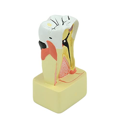 Modell der Zähne der Pathologie Parodontalmodell aus PVC für den Zahnarztunterricht im Studentenstudio Wissenschaft Zahnstudio Zahnmodul Pathologie für die Wissenschaft von MFYHMY