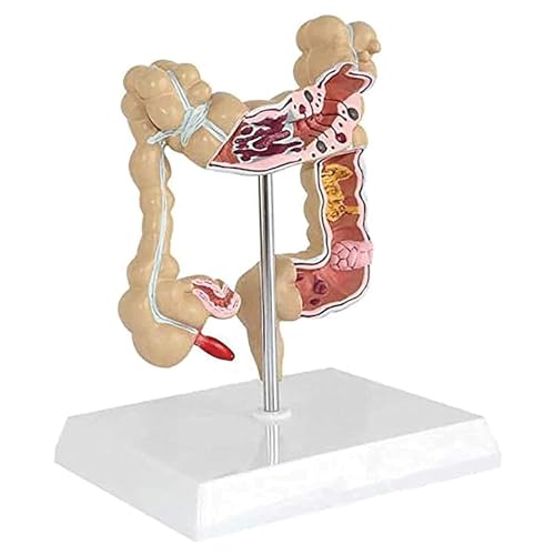 Modell des menschlichen Organs, anatomisches Modell, pathologisch, großes Modell der Verletzung menschlicher Darmerkrankungen, geeignet für den medizinischen Unterricht für das Schulstudium von MFYHMY