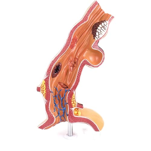 Modell eines menschlichen Organs, Modell einer kranken Speiseröhre, Modell einer menschlichen Krankheit, Modell einer pathologischen Anatomie der Speiseröhre, für das Krankenhaus für die Schulstudie von MFYHMY