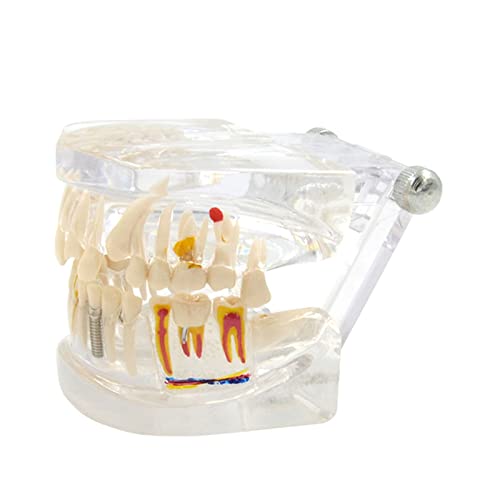 Zahnmodell pro System, abnehmbare Zähne, 9,5 x 6,9 x 6,9 cm, für Zahnarzt, Büro, Unterricht, Unterricht, Zähne, System, Modell von MFYHMY